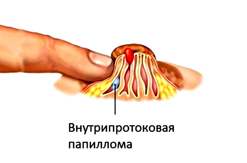 симптомы папилломы