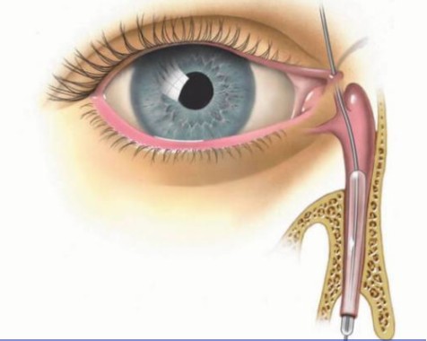 Стеноз слёзных протоков Arimed