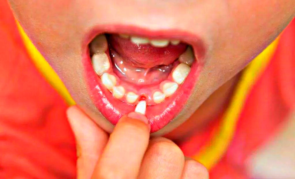 Почему у ребенка поздно выпадают молочные зубы