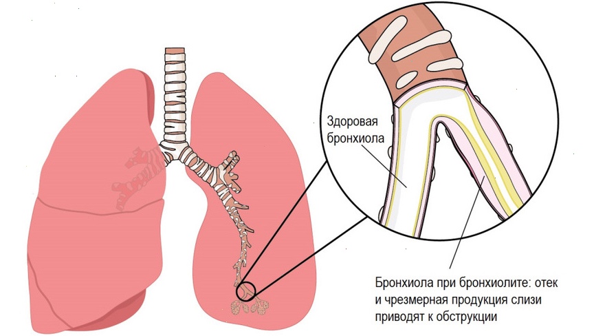 Бронхиолит