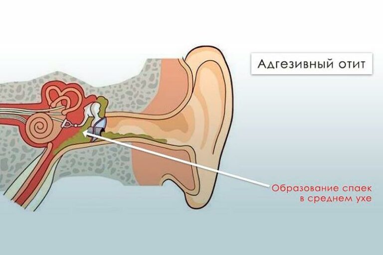 Адгезивный средний отит. Хронический адгезивный отит.