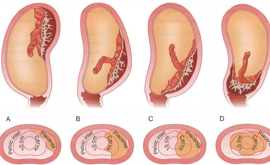 Патология локализации плаценты. Преимущественная локализация плаценты. Аномальное расположение плаценты. Матка в 4 месяца