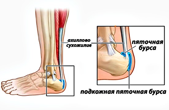 причины ахиллобурсита