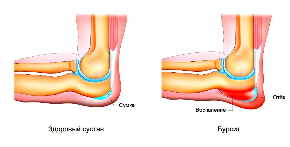 причины локтевого бурсита