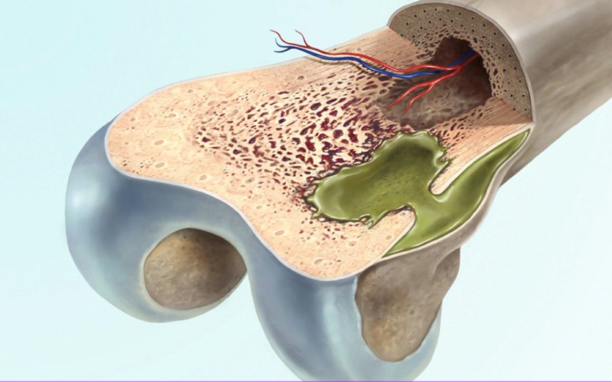 Воспаление костного мозга сустава. Остеомиелит инфекция костной. Остеомиелит костного мозга. Хронический остеомиелит большеберцовой кости.