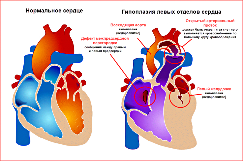 Синдром гипоплазии левых отделов сердца