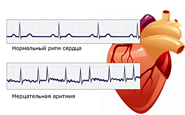 Синдром гипоплазии левых отделов сердца