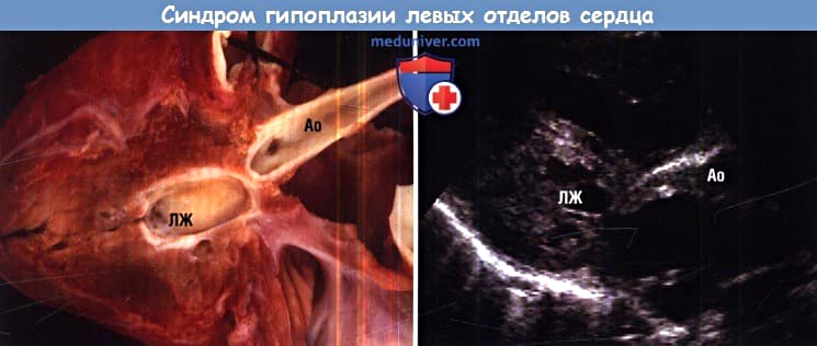 Синдром гипоплазии левых отделов сердца