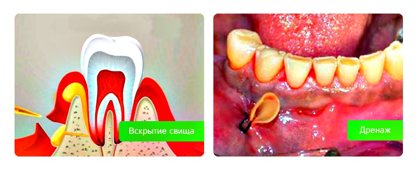 хирургическое вмешательство