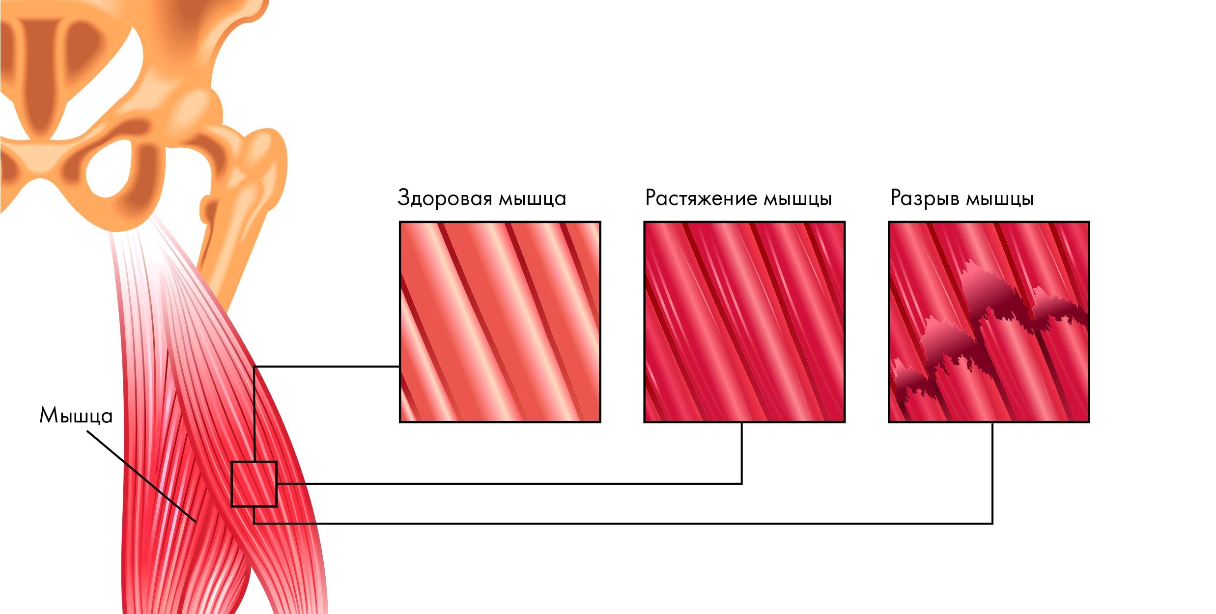 растяжение