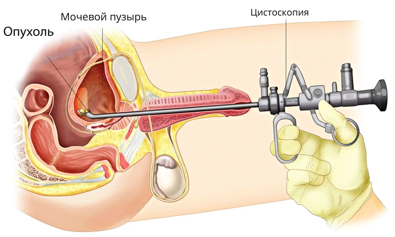 Рези и боли при мочеиспускании, почему это происходит