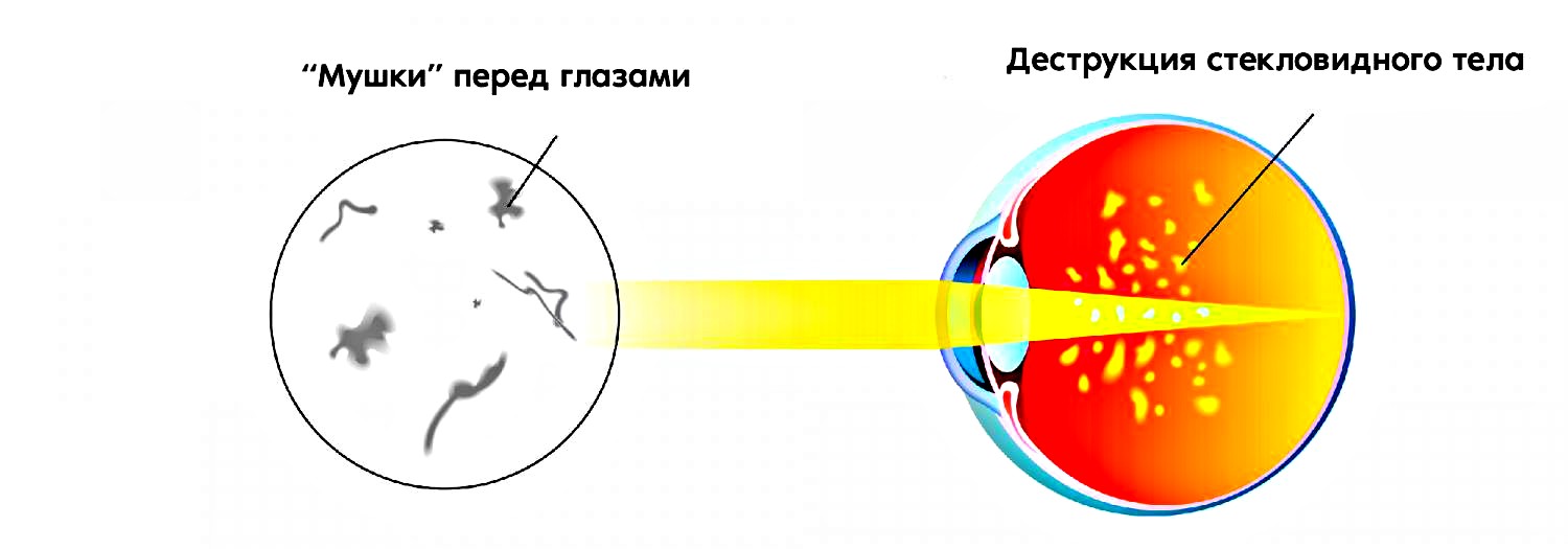 причины пятен перед глазами
