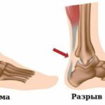 Разрыв сухожилия Arimed