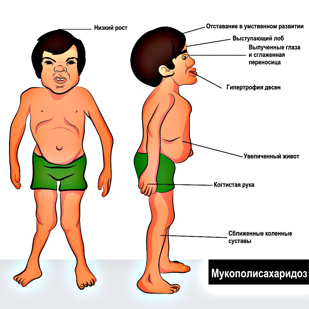 симптомы мукополисахаридоза