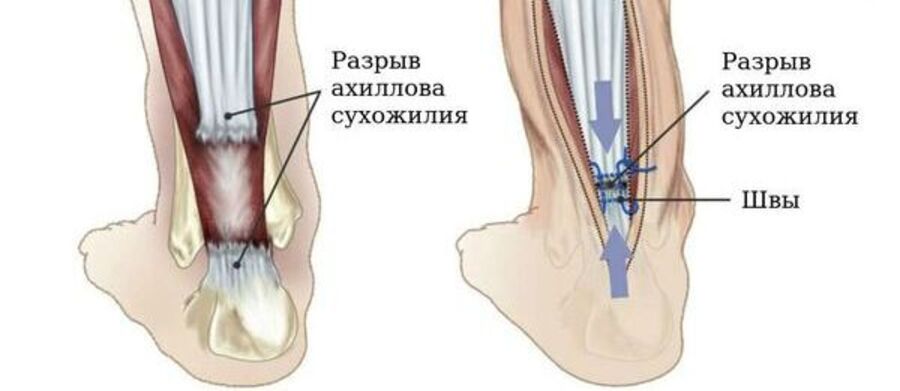 Разрыв сухожилия