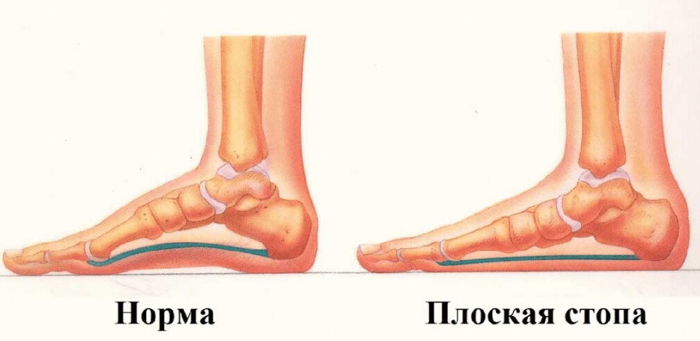 Плоскостопия у беременных