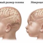 Микроцефалия Arimed
