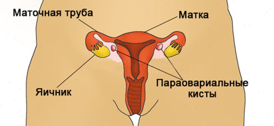 Параовариальная киста Arimed