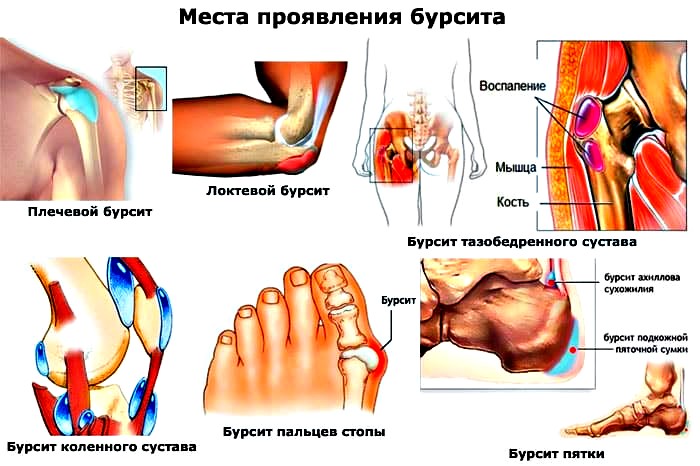 виды бурсита