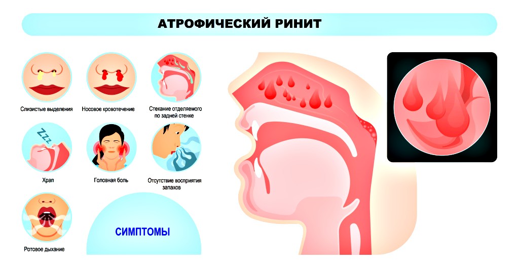 симптомы ринита