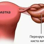 Перекрут ножки кисты яичника при беременности Arimed