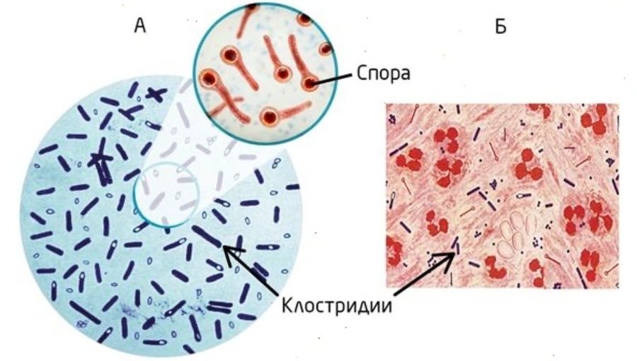 Газовая гангрена Arimed