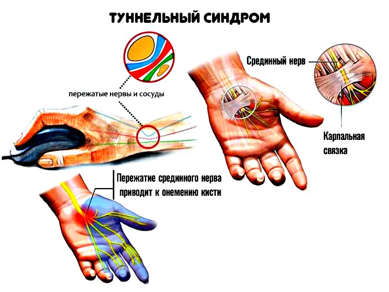 сдавливание нерва
