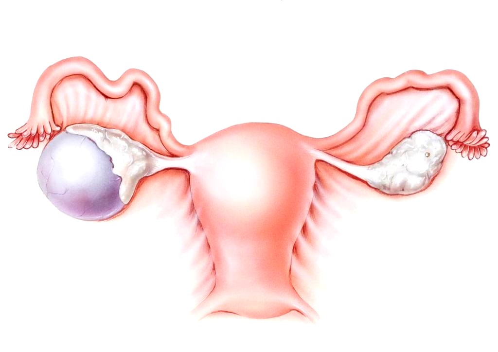 Киста яичника: что это, признаки на УЗИ и лечение