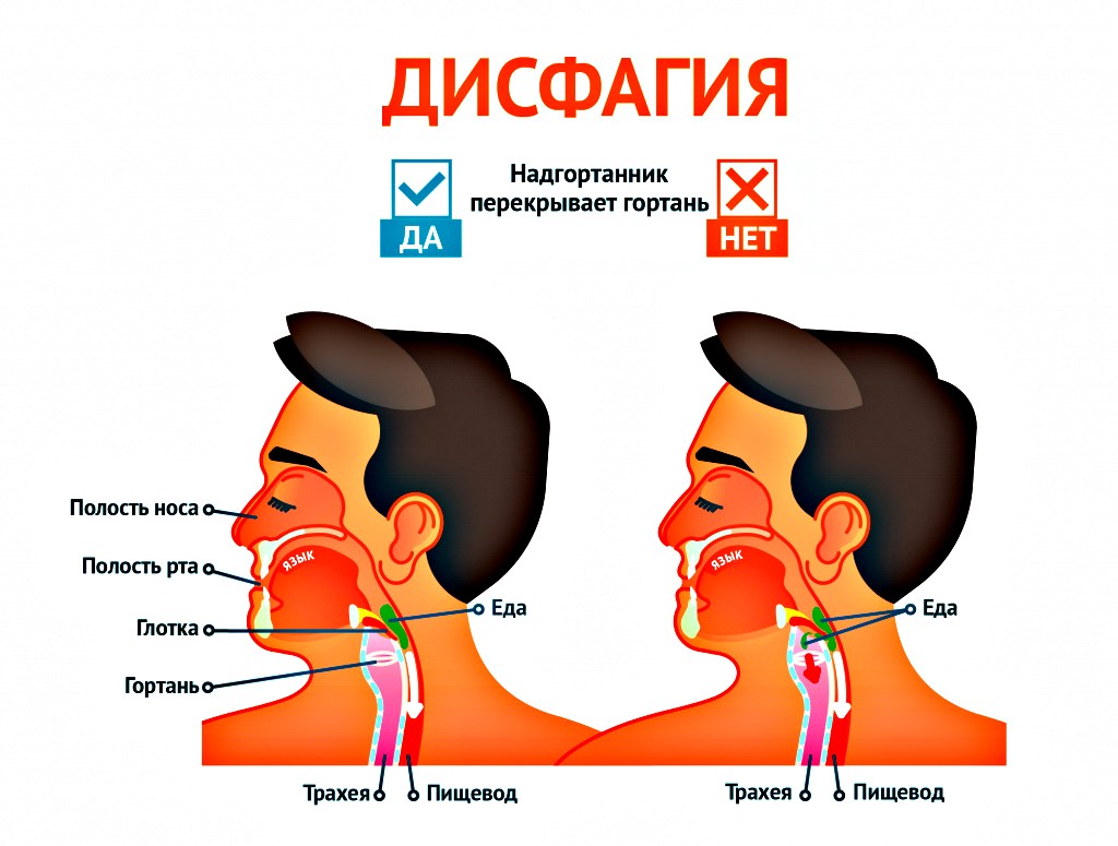 причины дисфагии
