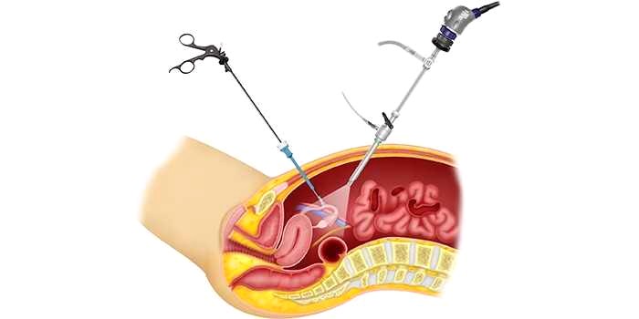 Восстановление после лапароскопии кисты яичника