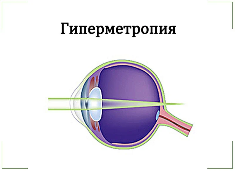 Гиперметропия