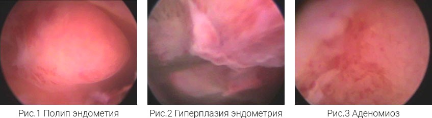 гистероскопия