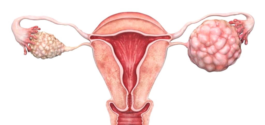 Доброкачественные опухоли яичников