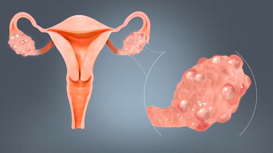Киста яичника: размеры в см и нормы