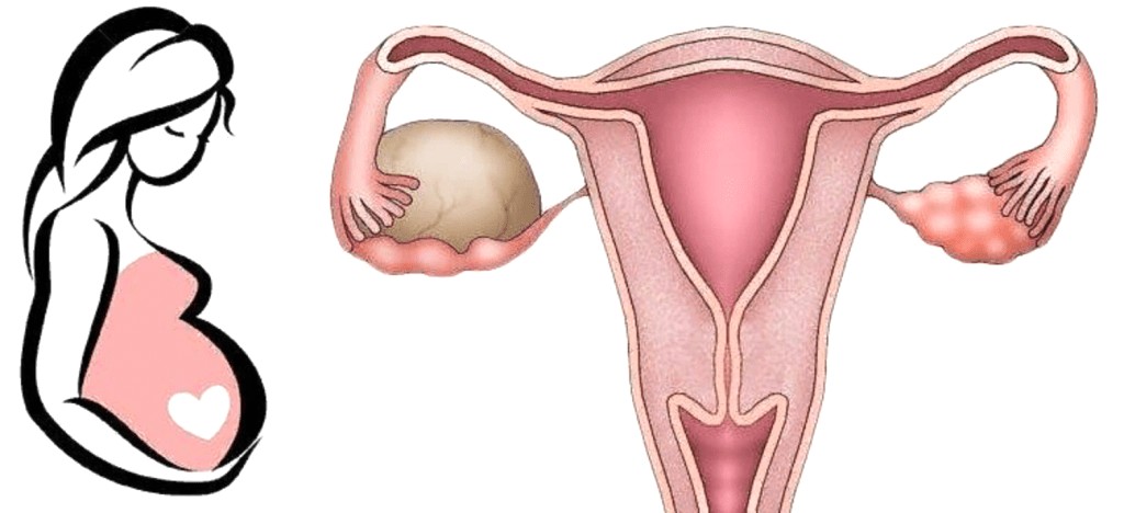 Беременность с кистой яичника: влияние на зачатие и лечение