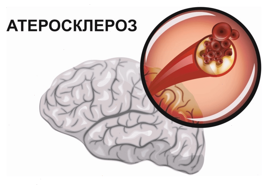 Атеросклеротическая деменция Arimed