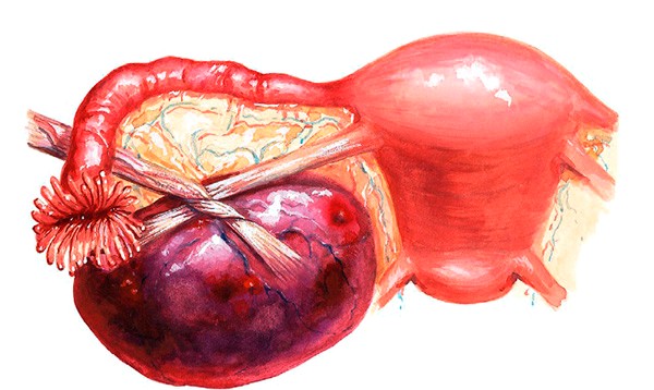 Перекрут кисты яичника