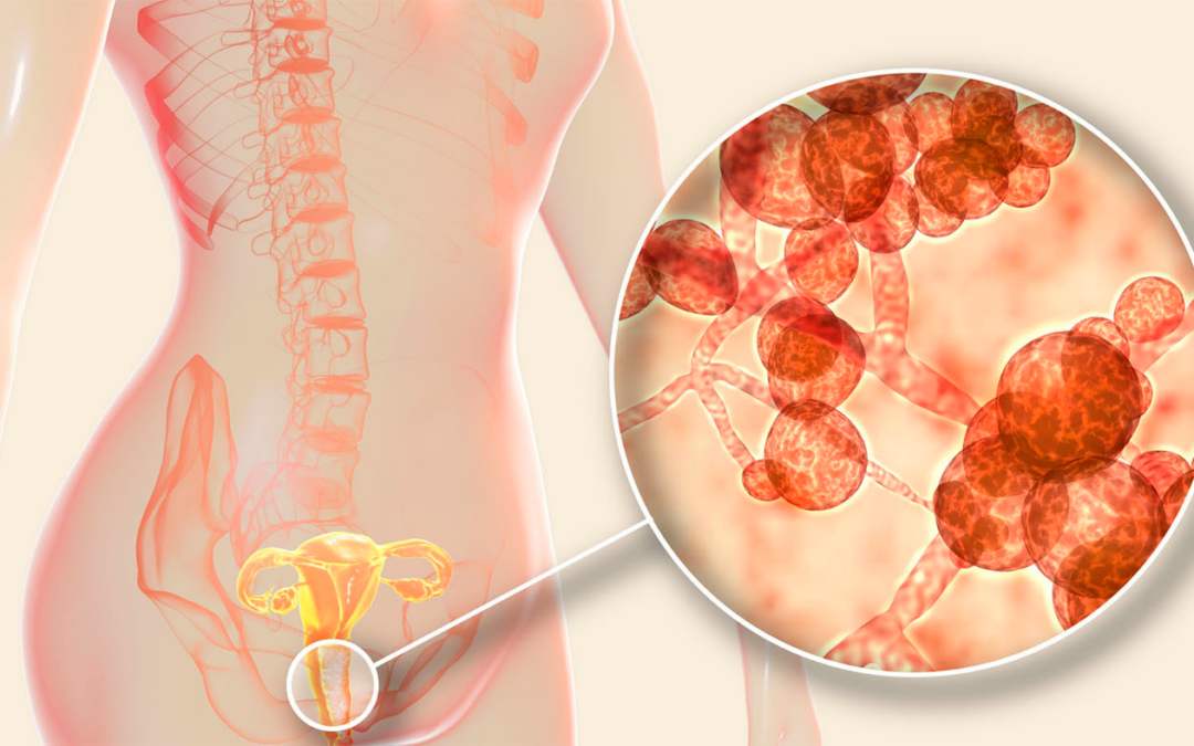 Грибковые инфекции влагалища