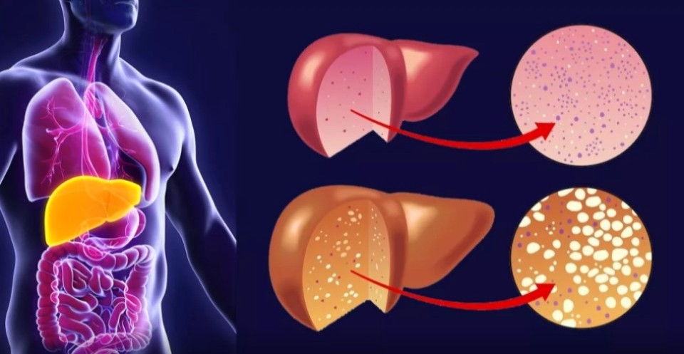 Жировая болезнь печени, что делать?