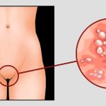 Генитальный герпес у женщин Arimed