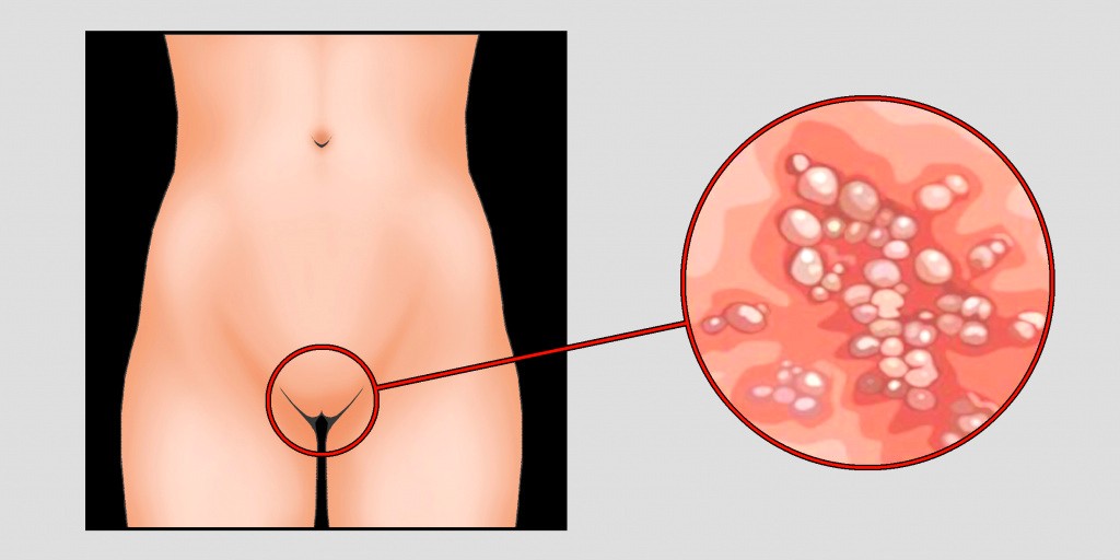 Генитальный герпес у женщин