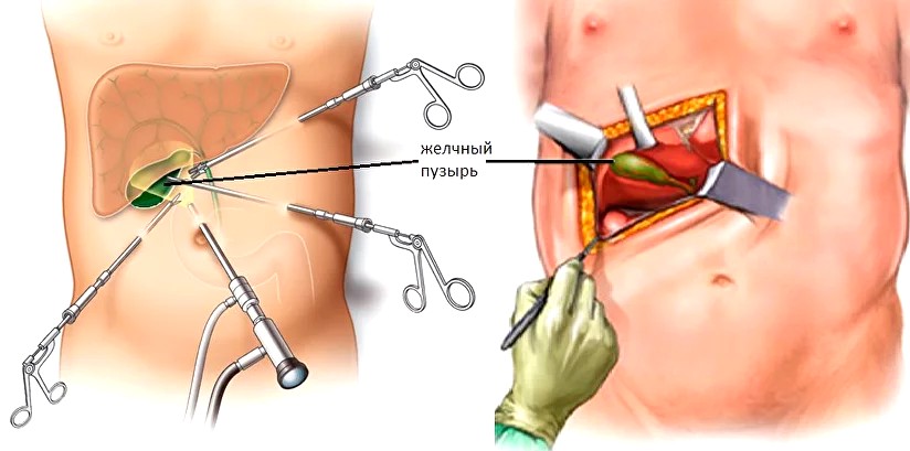 холицистэктомия