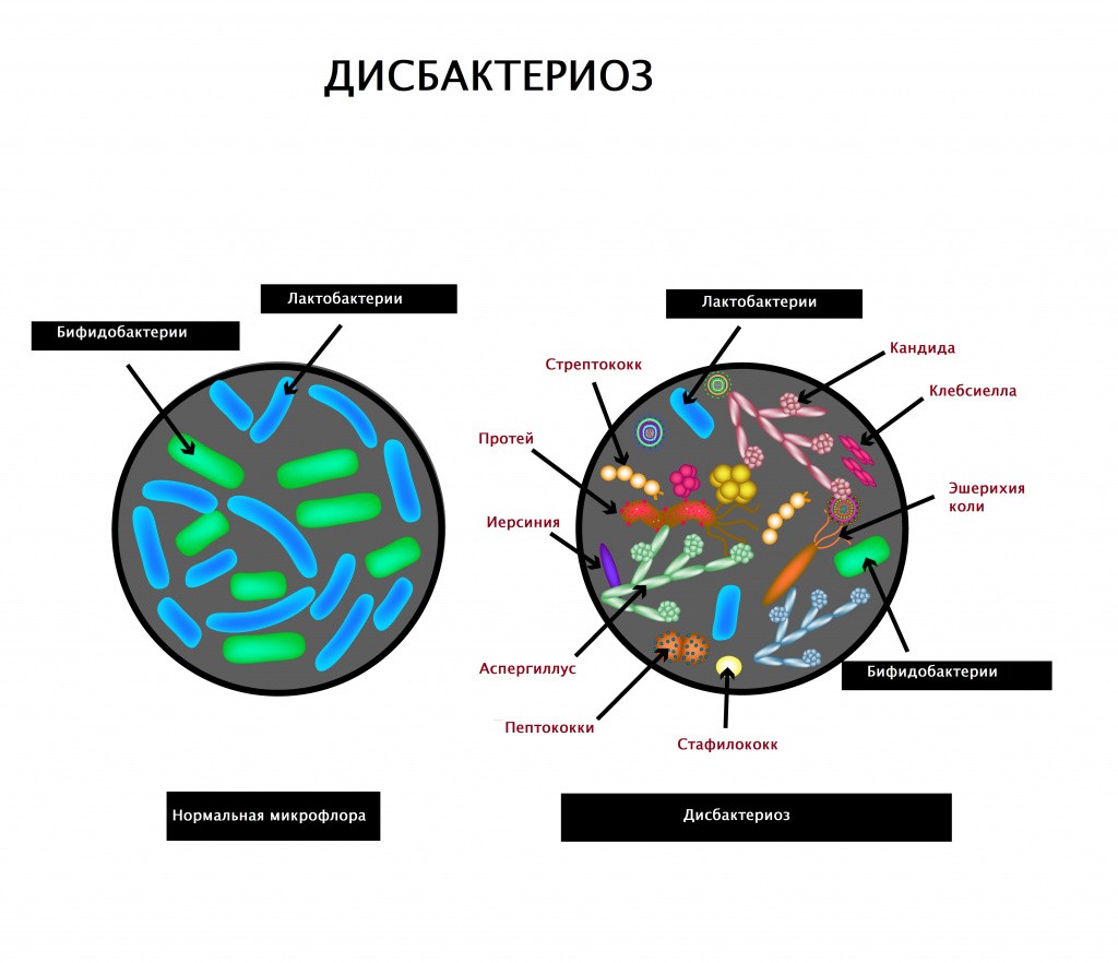 дисбактериоз