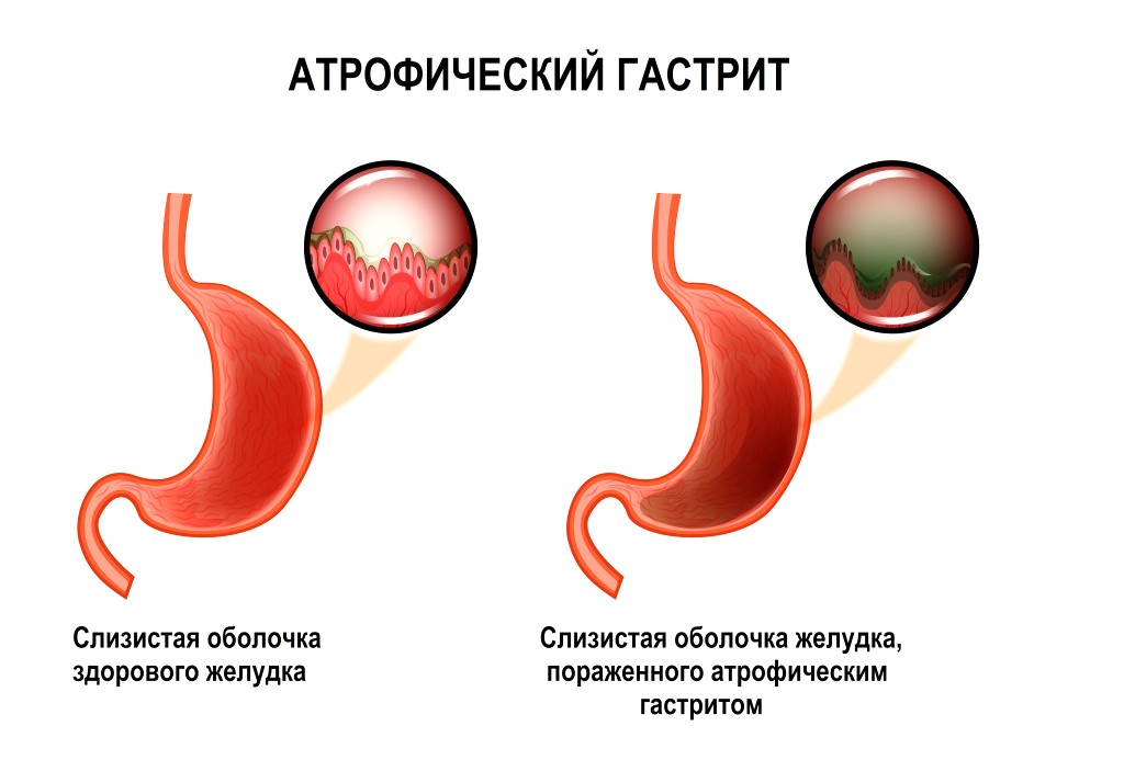 атрофический гастрит