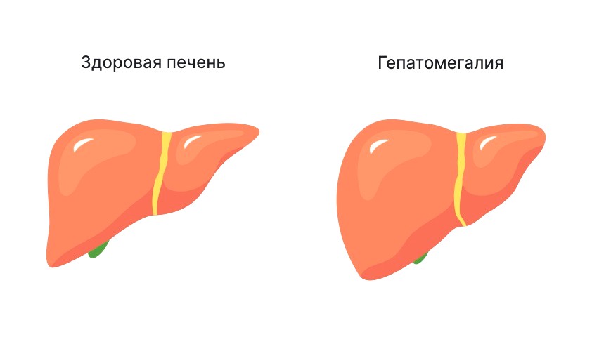 гепатомегалия