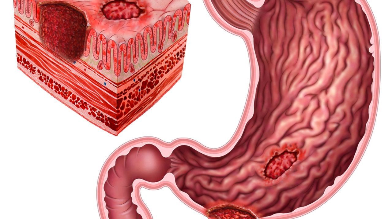 Почему у меня не проходит язва в желудке