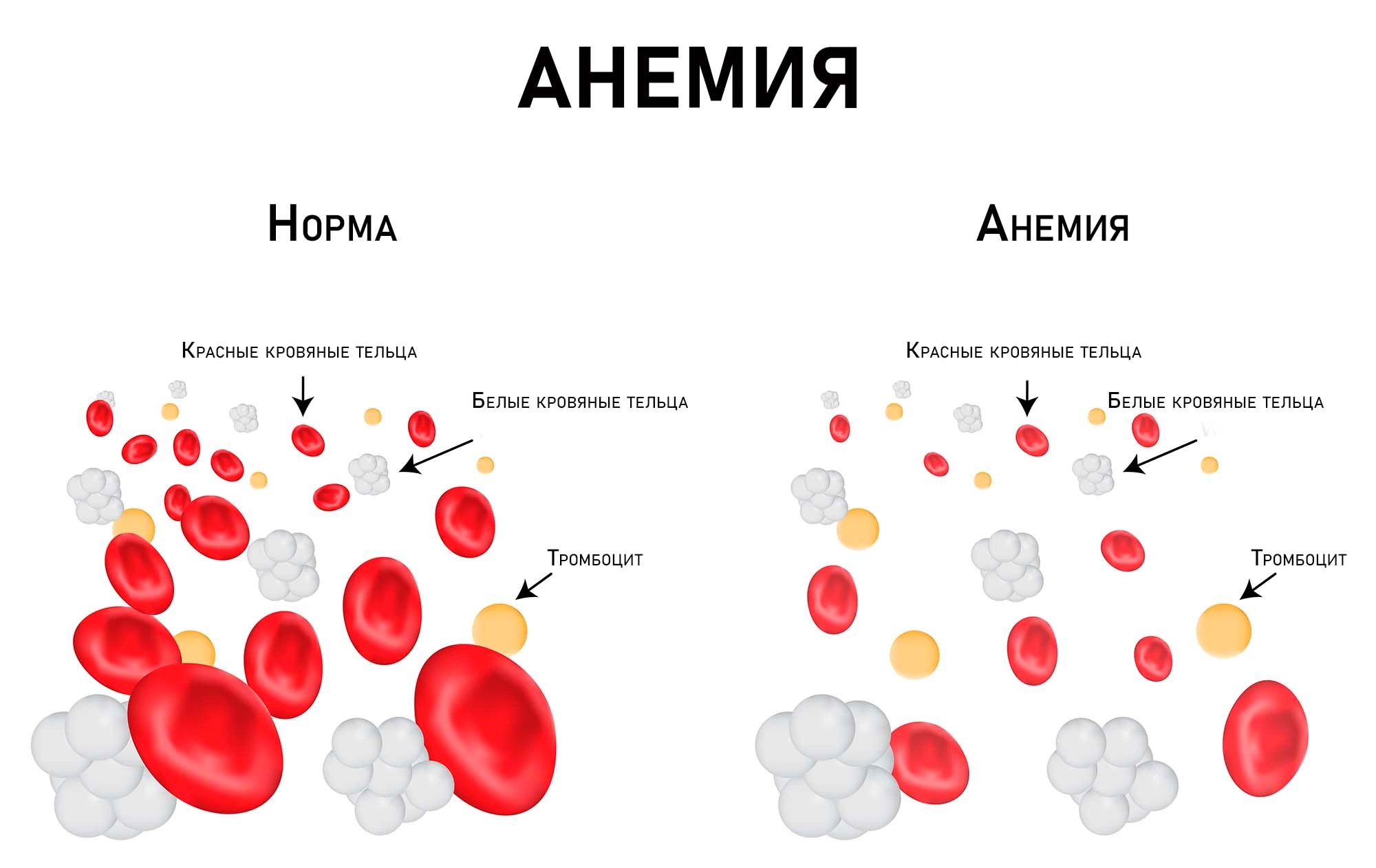 анемия