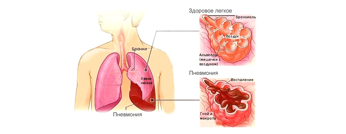 пневмония