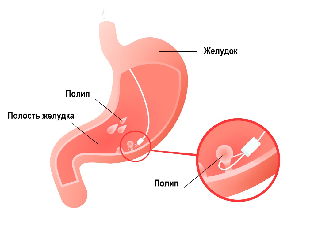 удаление полипов в желудке
