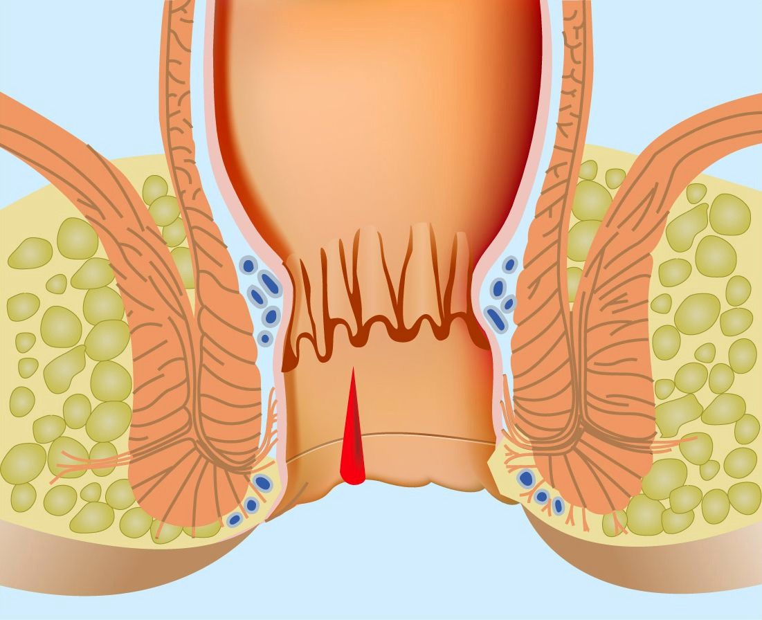 Пошла кровь из ануса, что делать?